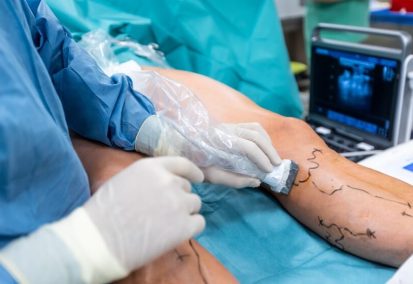Cirurgia-de-Varizes